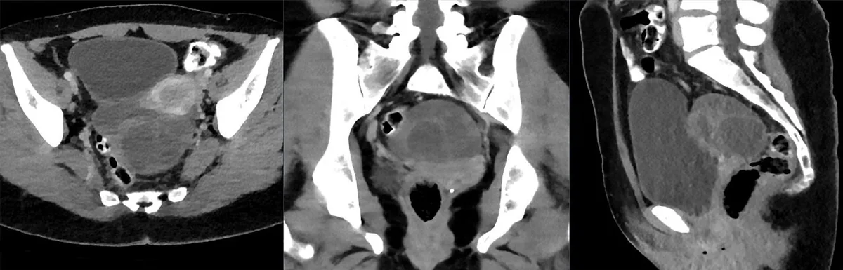 Krukenberg tumour – Mammography/MRI: CT (pelvis, contrast-enhanced, axial/coronal/sagittal): Krukenberg tumour from gastric carcinoma – solid-cystic ovarian mass posterior to the uterus in a 40-year-old woman