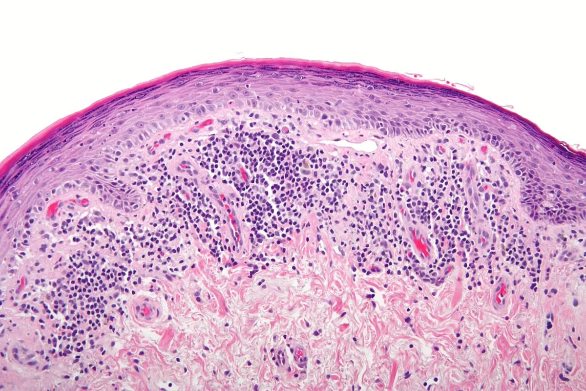 Lichen planus der Vulva – Histologie & Zytologie: Histologie (HE): Lichen planus (Hautbiopsie) – bandförmiges lymphozytäres Infiltrat an der Junktionszone mit Interface-Dermatitis und Schädigung der Basalzellschicht; gleiches …