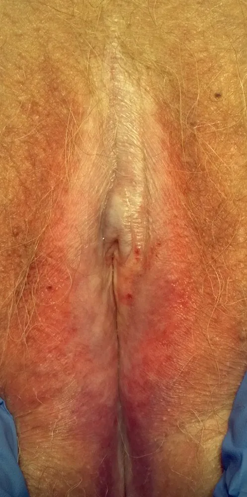 Lichen sclerosus der Vulva – Klinik: Lichen sclerosus der Vulva: elfenbeinweiße, atrophe Haut, Verstreichen der Labia minora