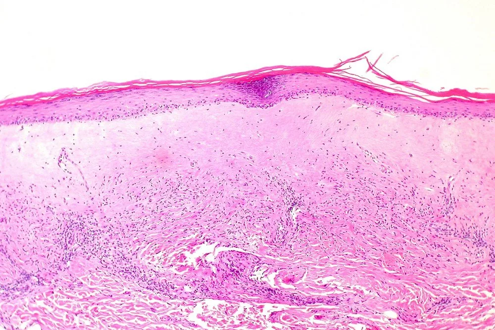 Lichen sclerosus der Vulva – Histologie & Zytologie: Histologie (HE) des Lichen sclerosus: Epidermisatrophie über einem breiten Band homogenisierten Kollagens, darunter ein lymphozytäres Infiltrat