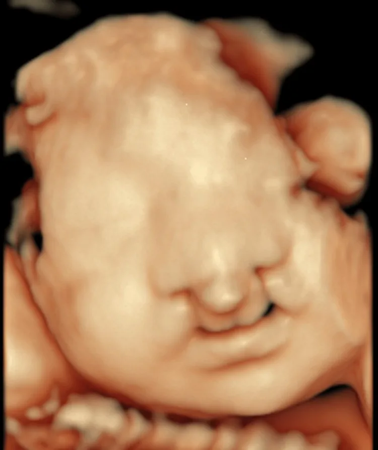 Cleft lip and palate (prenatal) – Ultrasound