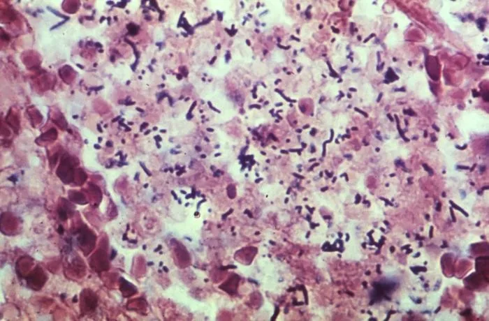 Listeriose in der Schwangerschaft – Histologie & Zytologie: Histologie (Silberimprägnation nach Levaditi): zahlreiche stäbchenförmige Listeria monocytogenes im Lungengewebe eines Neugeborenen mit Listeriose