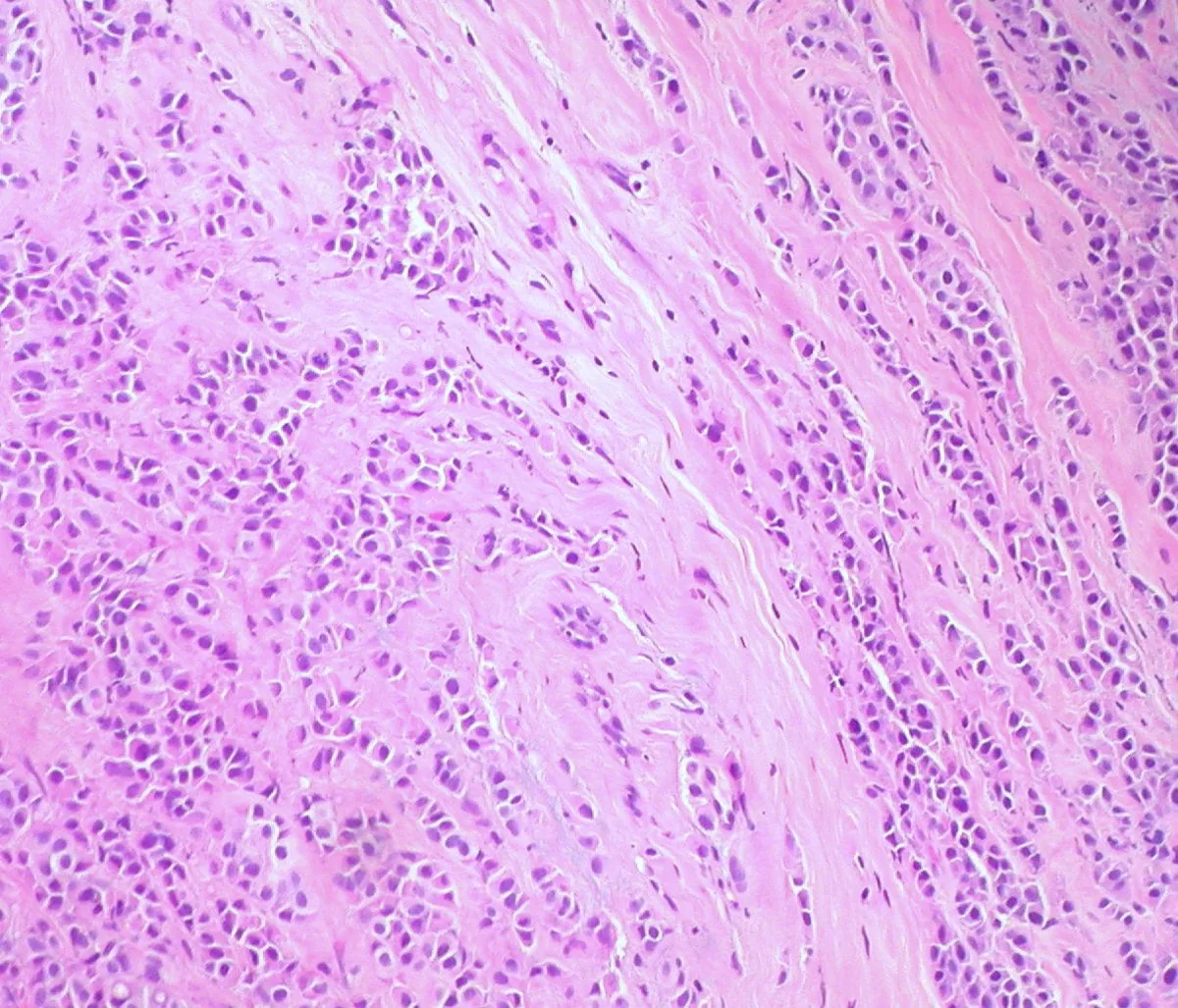 Lobuläres Mammakarzinom und lobuläre Neoplasie – Histologie & Zytologie: Histologie (HE): invasives lobuläres Mammakarzinom – kleine, monomorphe, wenig kohäsive Tumorzellen in Einzelzellreihen (Gänsemarsch) zwischen Kollagenfasern