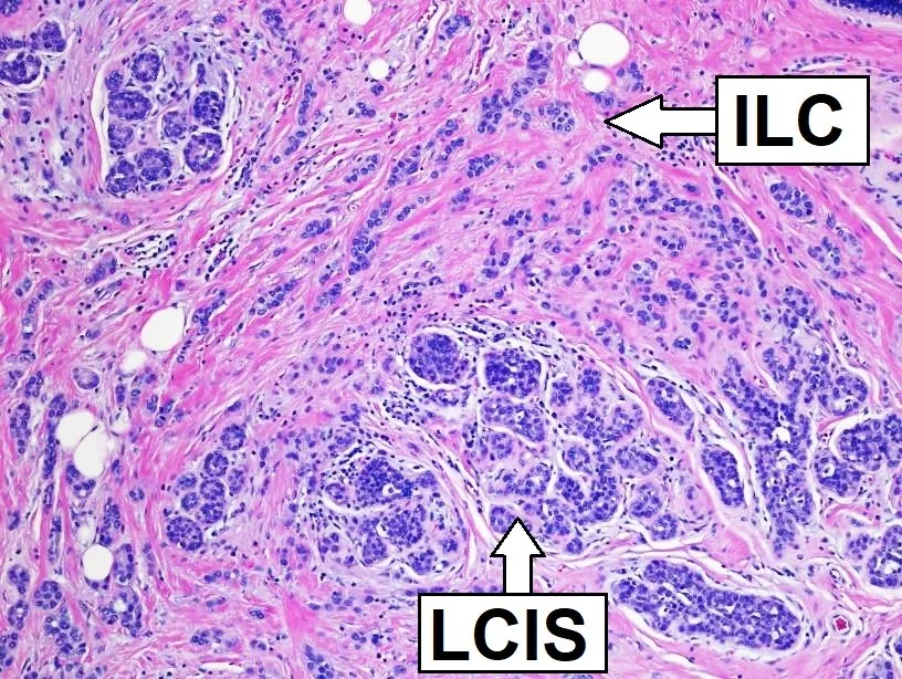 Lobuläres Mammakarzinom und lobuläre Neoplasie – Histologie & Zytologie: Histologie (HE): invasives lobuläres Karzinom (ILC) neben lobulärem Carcinoma in situ (LCIS), das die Azini ausfüllt