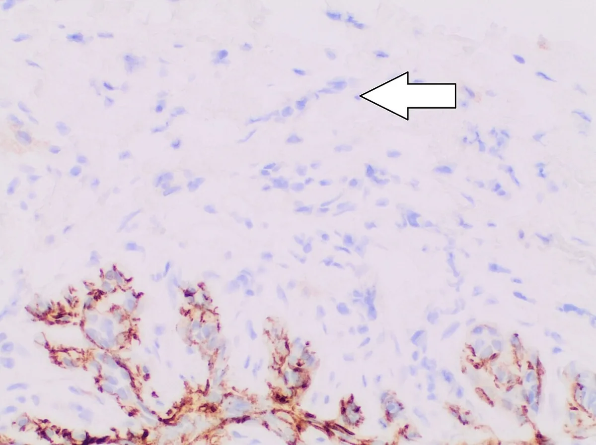 Lobuläres Mammakarzinom und lobuläre Neoplasie – Histologie & Zytologie: Immunhistochemie E-Cadherin: Tumorzellen des lobulären Karzinoms negativ (blau, Pfeil auf Einzelzellreihe), regulärer Gang unten mit membranöser Positivkontrolle