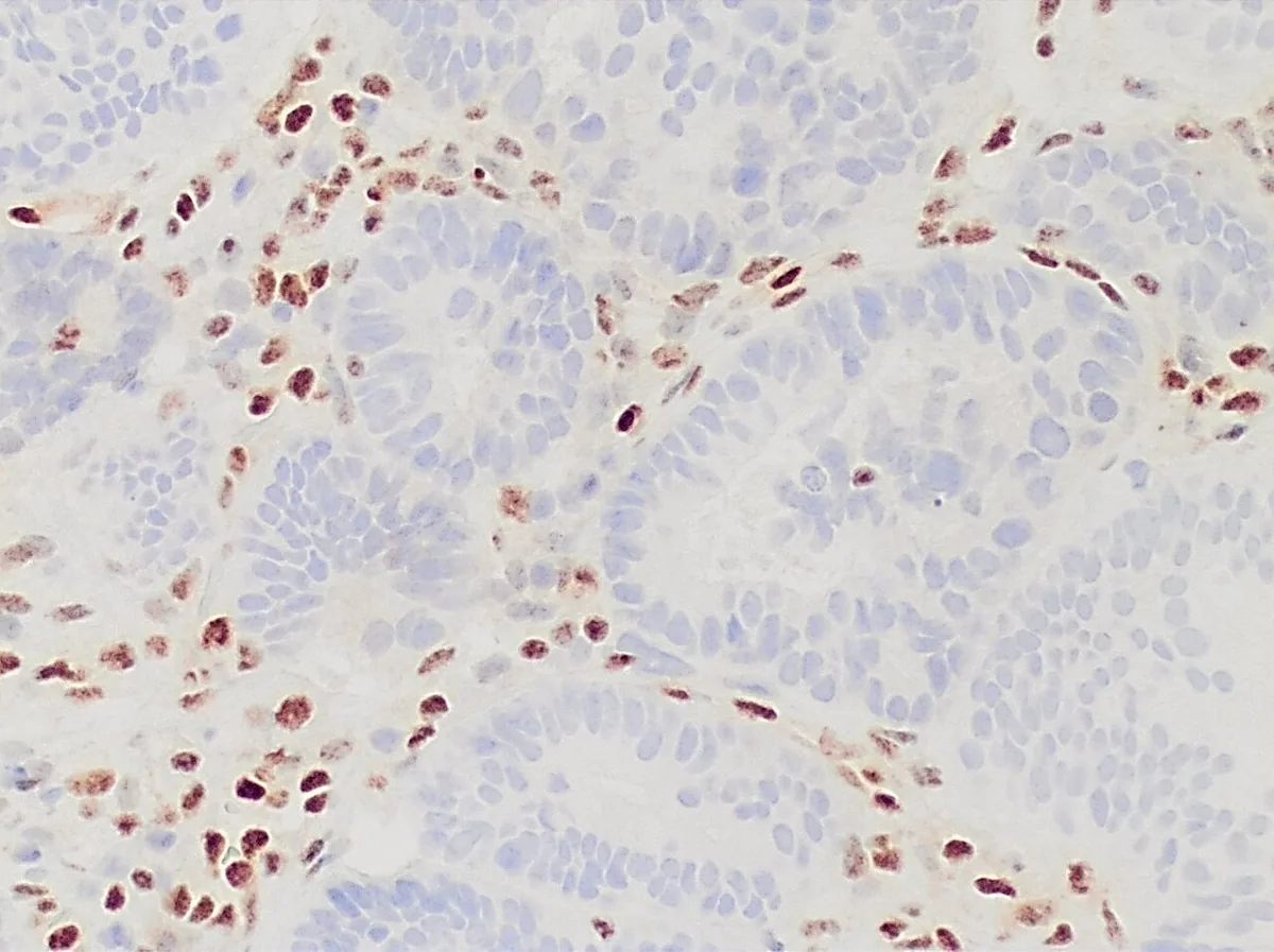 Lynch syndrome in gynaecology – Histology & cytology: MLH1 immunohistochemistry: loss of nuclear MLH1 expression in the glands of an endometrioid endometrial carcinoma (blue), stromal and inflammatory cells brown as internal positive …