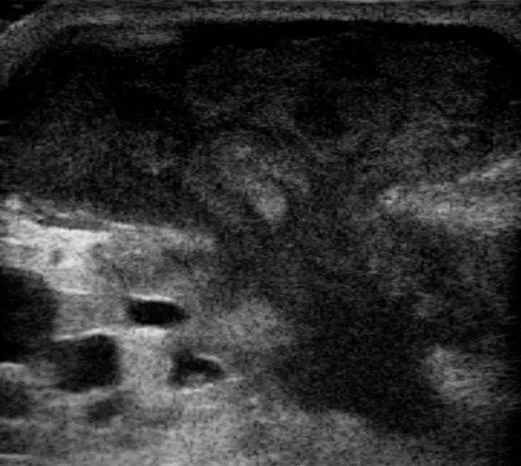 Breast abscess – Ultrasound: Breast abscess