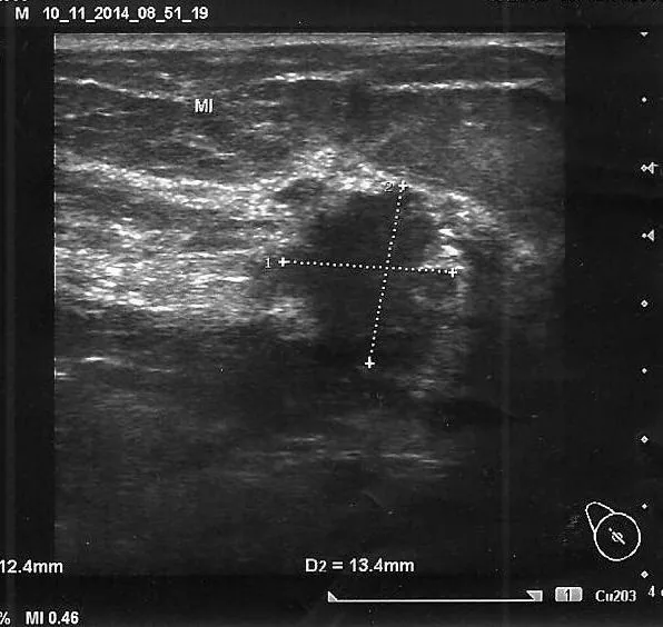 Mammakarzinom – Klinik: BI-RADS-4-Herd — echoarm, unscharf, höher als breit (D2 13,4 mm > D1 12,4 mm)