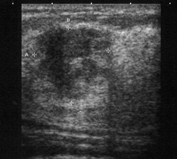Mammakarzinom – Sonographie: Mammasonographie: derselbe Herd höher als breit — vertikale Orientierung als Malignitätskriterium