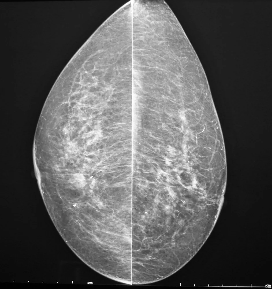 Mammakarzinom – Mammographie/MRT: Mammographie CC beidseits: lipomatöse Involution, Dichtekategorie ACR a/b