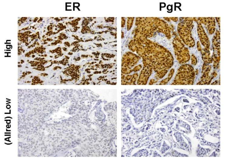 Mammakarzinom des Mannes – Histologie & Zytologie: Immunhistochemie: Mammakarzinom des Mannes mit Östrogen- (ER) und Progesteronrezeptor (PgR) – obere Reihe hohe, untere Reihe niedrige Expression (Allred-Score)