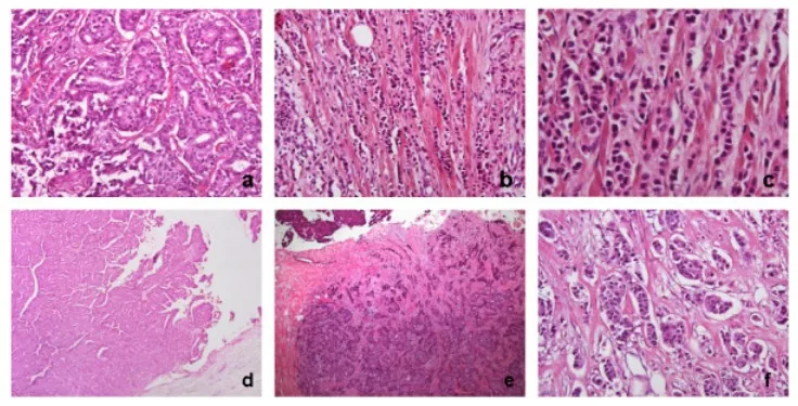Mammakarzinom des Mannes – Histologie & Zytologie: Histologie (HE): Subtypen des Mammakarzinoms beim Mann – a) invasiv-duktal (NST), b/c) invasiv-lobulär, d/e) invasiv-papillär, f) invasiv-mikropapillär