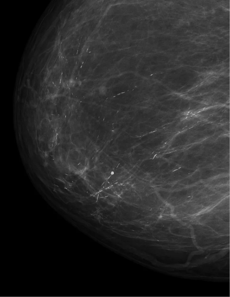 Non-puerperal mastitis – Ultrasound: Breast ultrasound: hypoechoic collection with an irregular wall — breast abscess