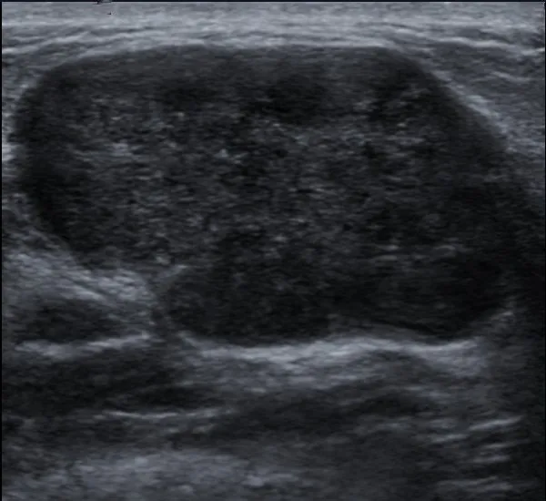 Non-puerperal mastitis – Clinical: Puerperal mastitis: wedge-shaped erythema and warmth of the lower outer quadrant