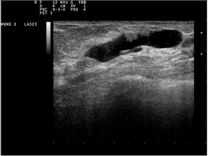 Non-puerperal mastitis – Ultrasound: Breast ultrasound: oval, smooth-bordered, homogeneously hypoechoic mass, wider than tall — typical fibroadenoma