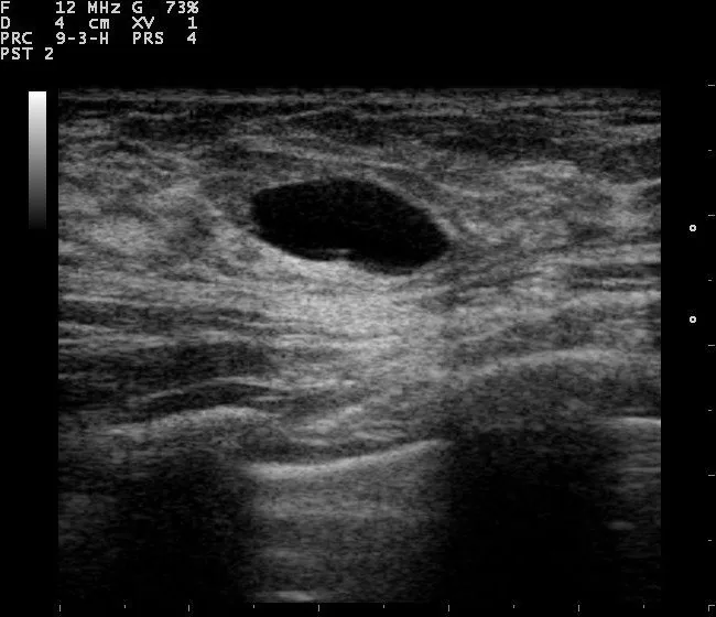 Fibrocystic breast changes and breast cysts – Ultrasound: Simple breast cyst