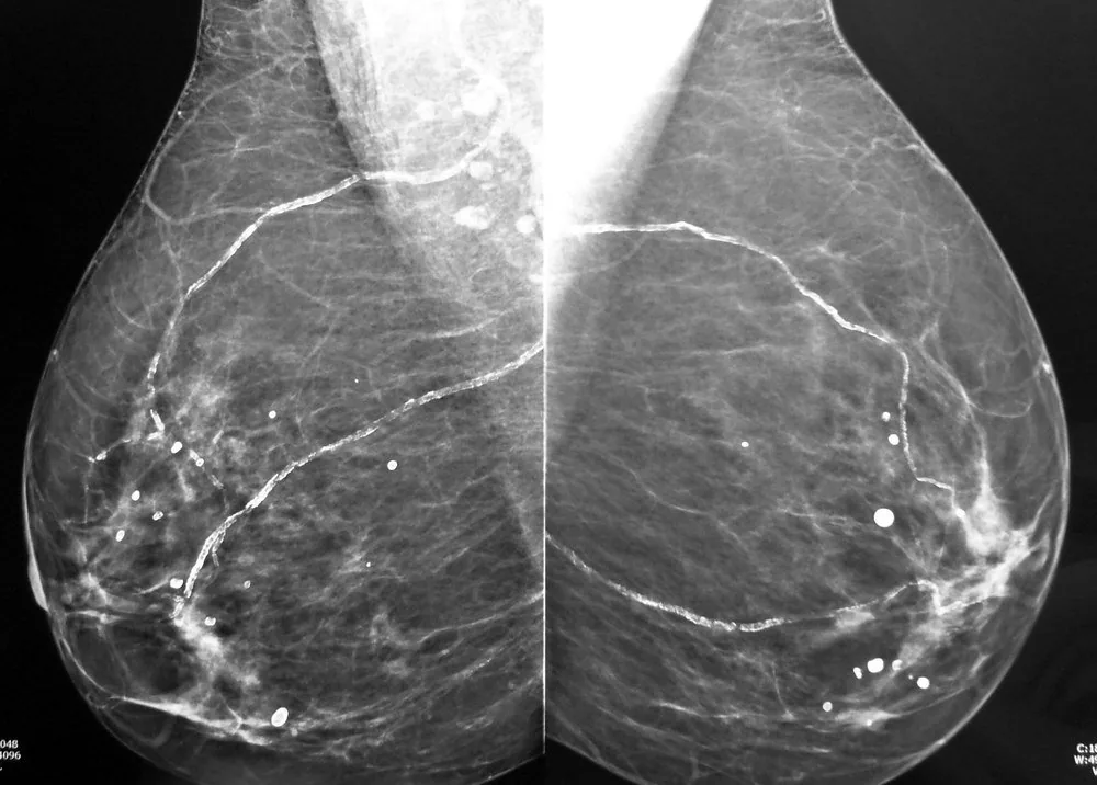 Fibrocystic breast changes and breast cysts – Mammography/MRI: Benign calcifications