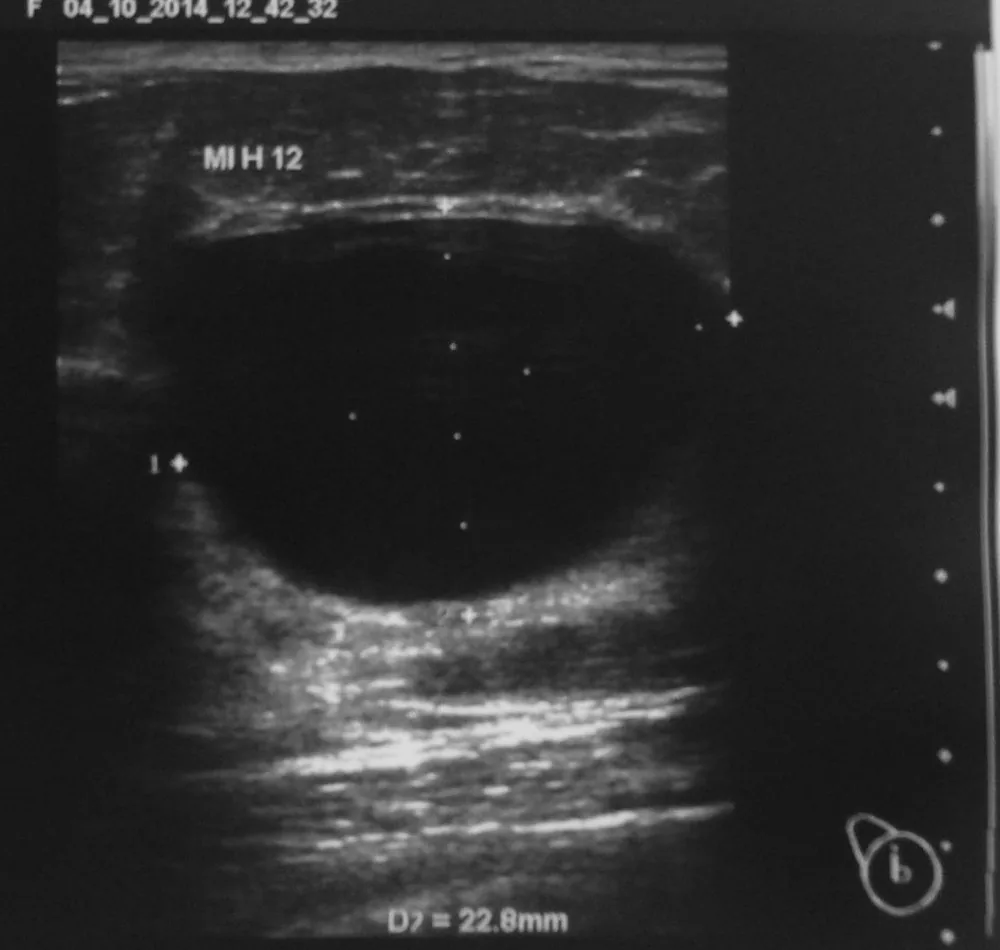 Fibrocystic breast changes and breast cysts – Clinical