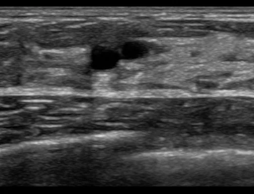 Fibrocystic breast changes and breast cysts – Clinical