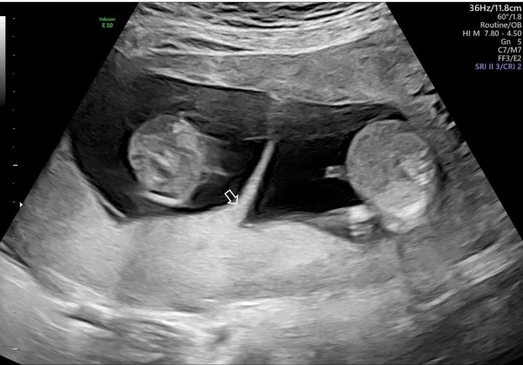 Multiple pregnancy – Ultrasound: Lambda (twin peak) sign at 13 weeks — a dichorionic twin pregnancy (Photo: Yoshimura Y, Ozawa K, Goto H, Yamazaki Y, Isohata H, Ochiai D. (Cureus, 2024), open access, CC BY 4.0)