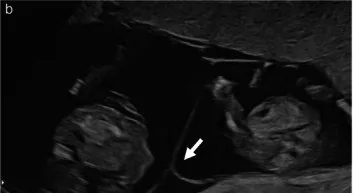 Multiple pregnancy – Ultrasound: T sign (empty lambda): the thin dividing membrane meets the placenta at a right angle — monochorionic diamniotic (Photo: Khalil A, Sotiriadis A, Baschat A, Bhide A, Gratacós E, Hecher K, …
