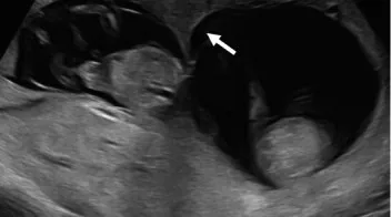 Multiple pregnancy – Ultrasound