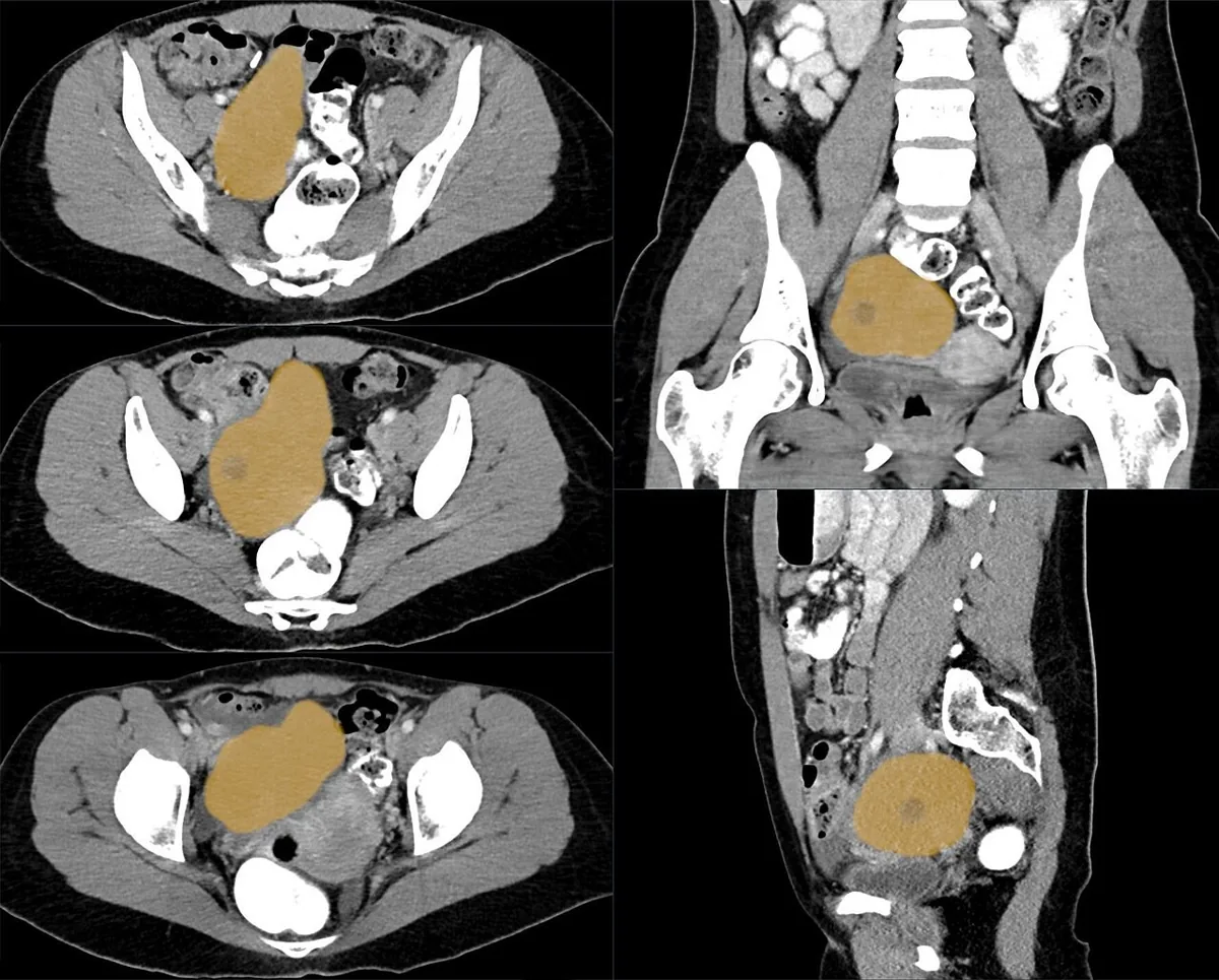 Meigs syndrome – Mammography/MRI: CT (pelvis, contrast-enhanced, axial/coronal/sagittal): right ovarian fibroma in a 37-year-old woman – large, smoothly marginated solid mass (marked in orange); fibromas are the typical …