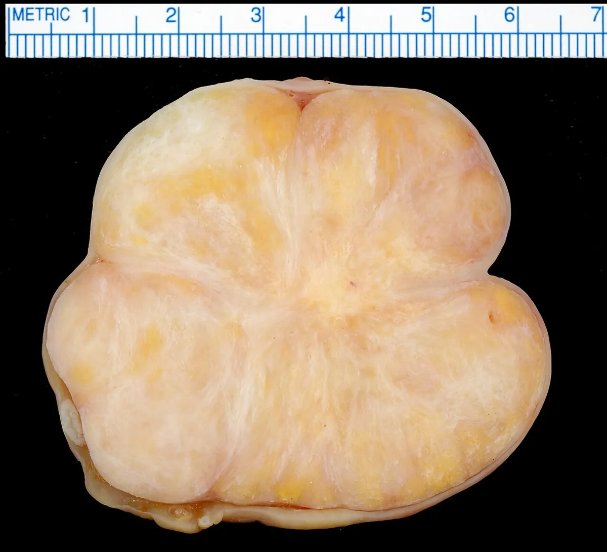 Meigs syndrome – Endoscopy & gross: Gross pathology: ovarian fibroma – firm, lobulated tumour with white-yellow fibrous cut surface; residual ovarian tissue only as a thin peripheral rim