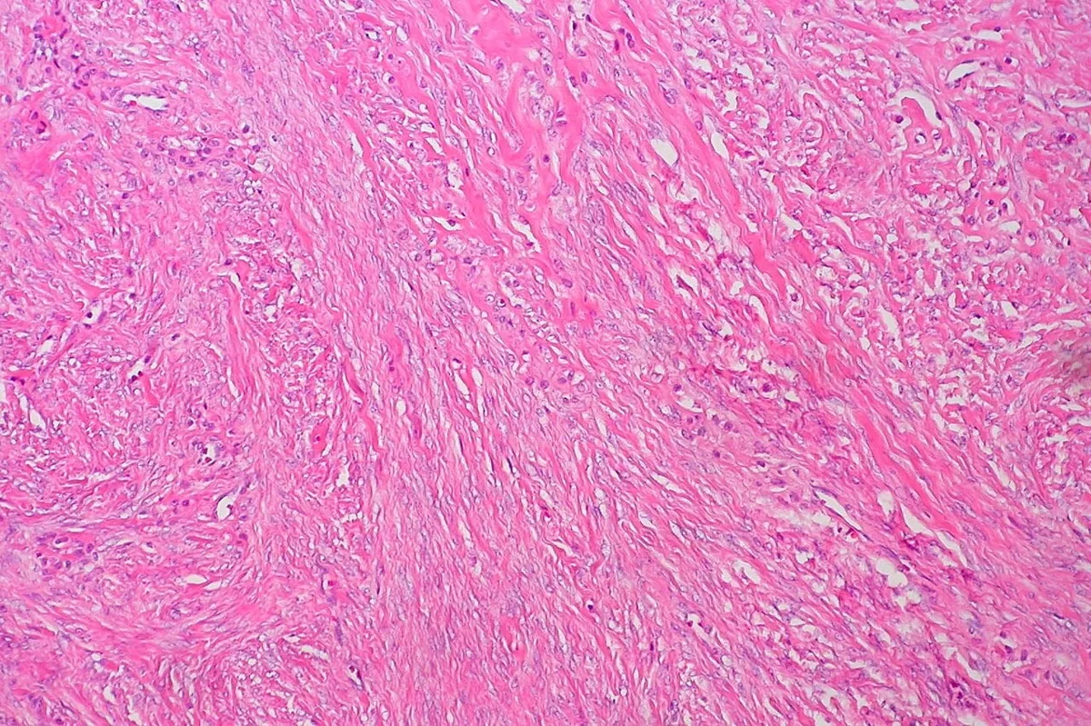 Meigs syndrome – Histology & cytology: Histology (H&E): ovarian fibroma – paucicellular proliferation of spindle-shaped fibroblasts with collagenous stroma in storiform fascicles