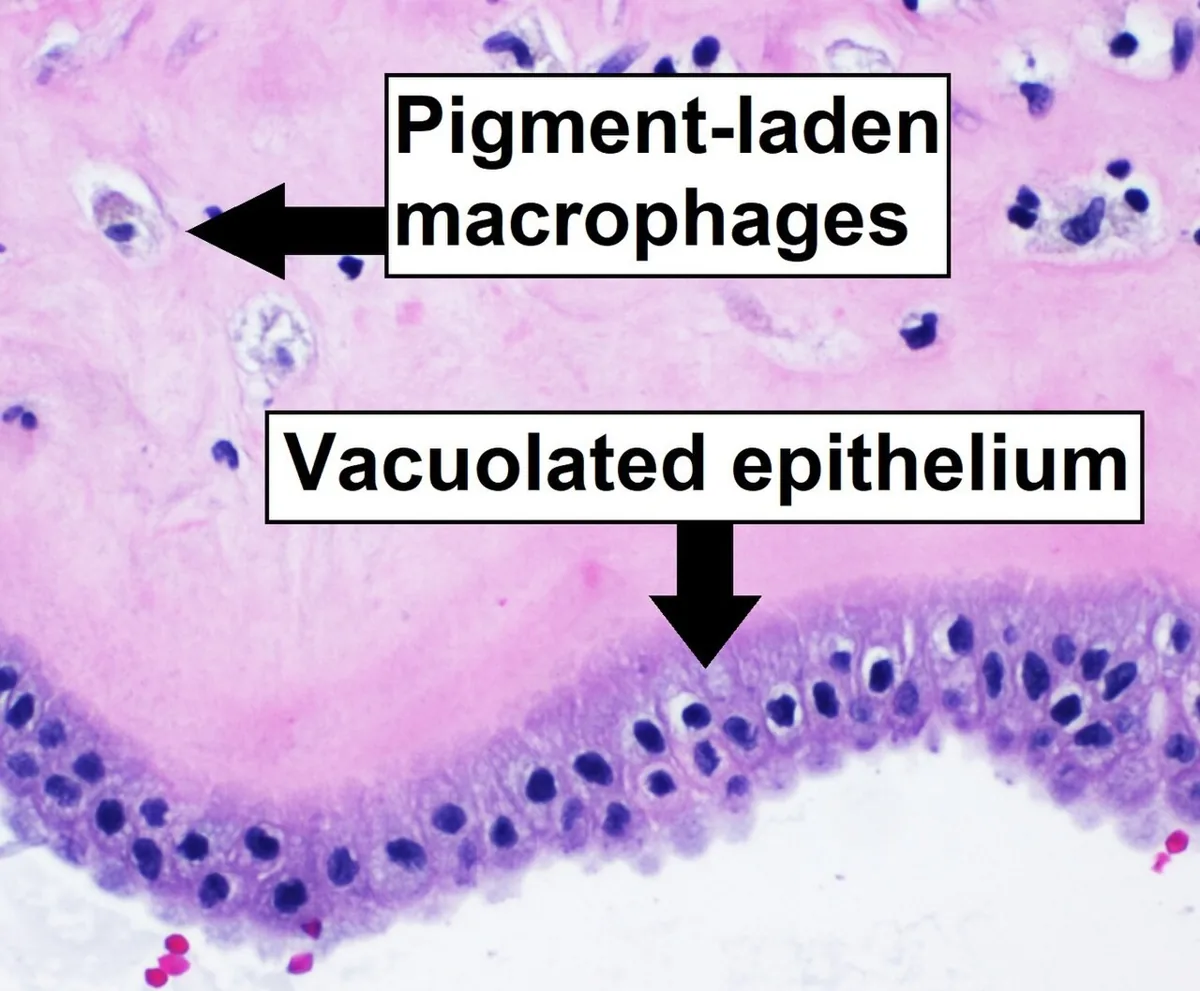 Meconium-stained amniotic fluid – Histology & cytology: Histology (H&E): pigment-laden macrophages (meconiophages) and vacuolated amnion epithelium as signs of meconium exposure