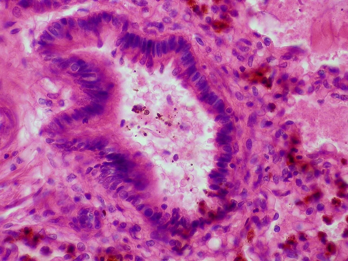 Meconium-stained amniotic fluid – Histology & cytology: Histology (H&E): meconium aspiration – aspirated squames and brownish meconium in a bronchiole and alveoli of the newborn