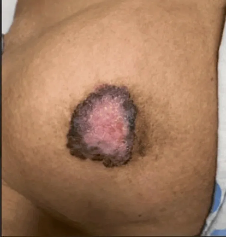 Morbus Paget der Mamille – Klinik: Morbus Paget der Mamille, klinisches Foto