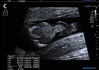 Omphalozele und Gastroschisis – Sonographie: Omphalozele in der 13. SSW: mittellinige Bauchwandvorwölbung am Nabelschnuransatz (Foto: Oelmeier K, Horváth J, Vogtmann R, Meyer-Wittkopf M, Möllers M, Schmitz R, Oberste KM, Willy D. …