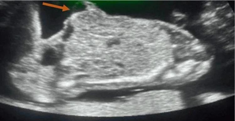 Omphalozele und Gastroschisis – Sonographie: Omphalozele: membranbedeckter Bruchsack am Nabel