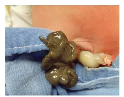Omphalozele und Gastroschisis – Sonographie: Gastroschisis postnatal (Foto des Neugeborenen)