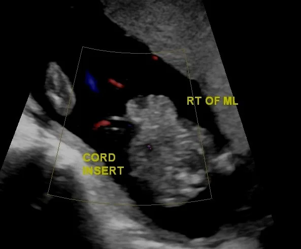 Omphalozele und Gastroschisis – Sonographie: Gastroschisis, Farbdoppler mit Nabelschnuransatz