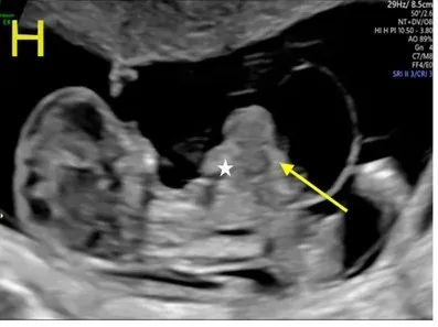 Omphalozele und Gastroschisis – Sonographie: Hohe Omphalozele mit Ectopia cordis (Pentalogie von Cantrell)