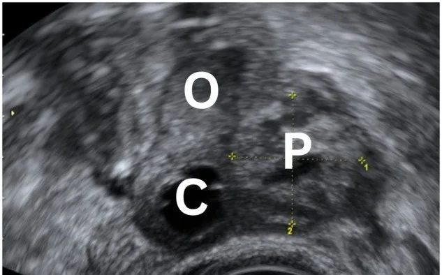 Ovarian pregnancy – Ultrasound