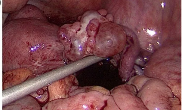Ovarialkarzinom – Endoskopie & Makro: Laparoskopie: bilaterale Ovarialtumoren mit Tumoraussaat im kleinen Becken (histologisch war dieser Fall ein Lymphom, makroskopisch das Bild eines Ovarialkarzinoms)