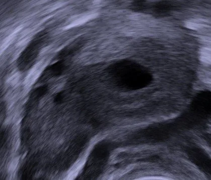 Ovarialzysten (Adnexzysten) – Sonographie: Transvaginalsonographie: Corpus luteum mit echofreiem Zentrum