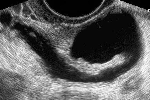 Ovarialzysten (Adnexzysten) – Sonographie: Transvaginalsonographie: geschlängelte, echofreie Tubenstruktur mit inkompletter Septierung — Hydrosalpinx