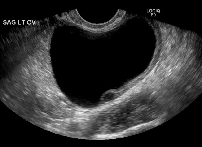 Ovarialzysten (Adnexzysten) – Sonographie: Transvaginalsonographie: einfache unilokuläre, echofreie Ovarialzyste von 5 cm