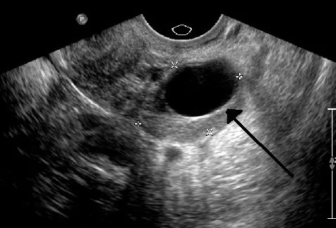 Ovarialzysten (Adnexzysten) – Sonographie: Einfache Ovarialzyste, 2 cm, transvaginale Sonografie
