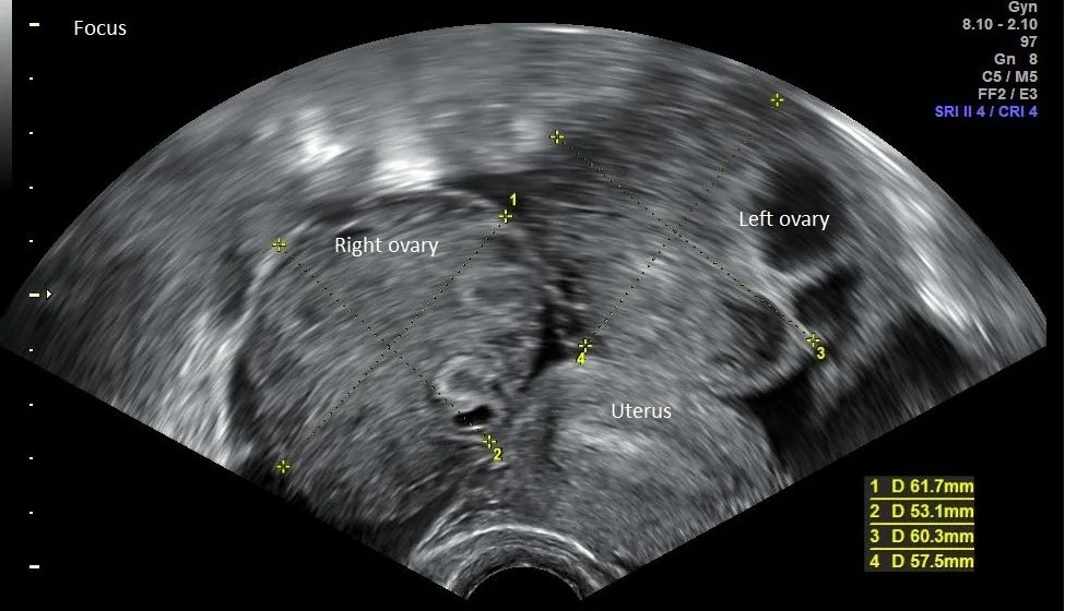 Ovarian hyperstimulation syndrome (OHSS) – Ultrasound