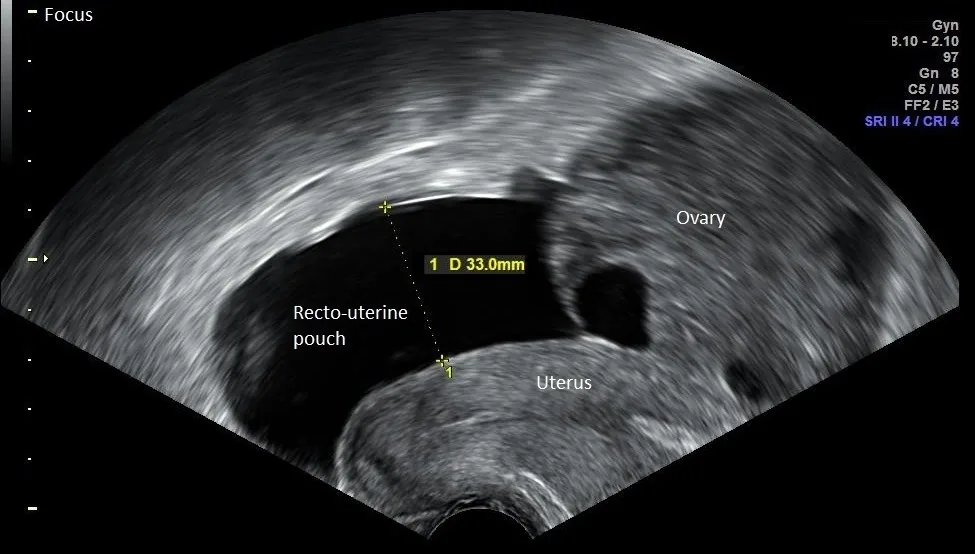 Ovarian hyperstimulation syndrome (OHSS) – Ultrasound