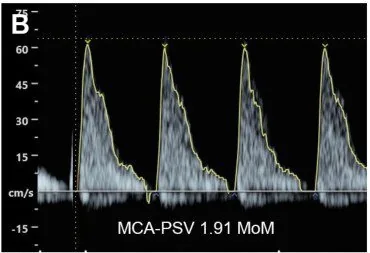 Parvovirus B19 in der Schwangerschaft – Sonographie: Doppler der A. cerebri media mit maximaler systolischer Geschwindigkeit von 1,91 MoM — Hinweis auf eine fetale Anämie (Foto: Yanase Y, Sirilert S, Jatavan P, Pomrop M, Phirom K, Tongsong …