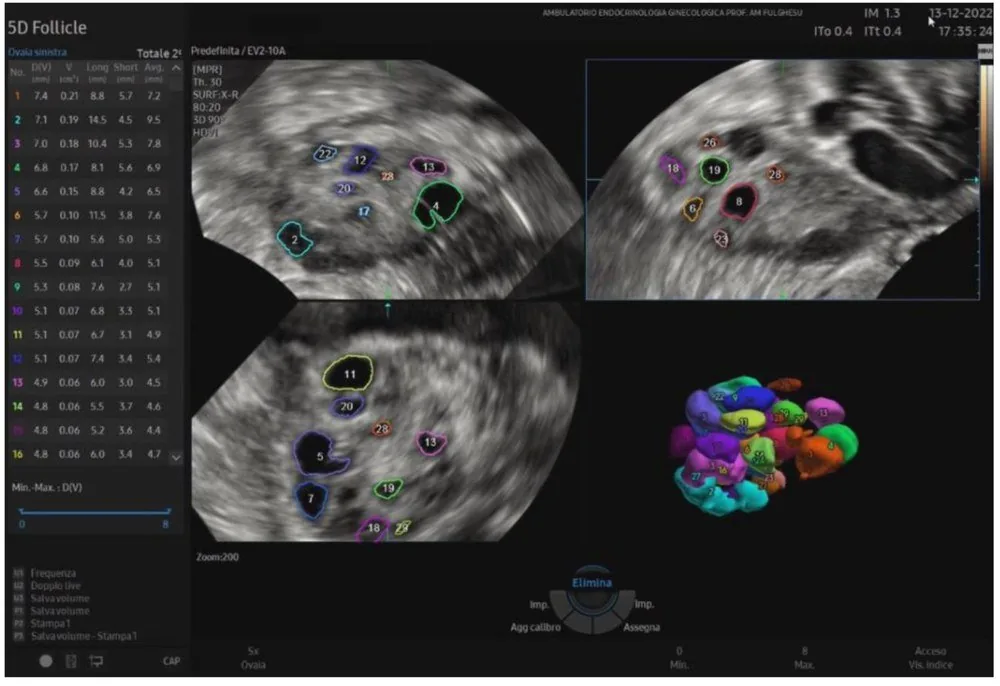 Polycystic ovary syndrome (PCOS) – Ultrasound: Transvaginal sonography with three-dimensional post-processing: the numerous follicles of a polycystic ovary are outlined in colour and numbered