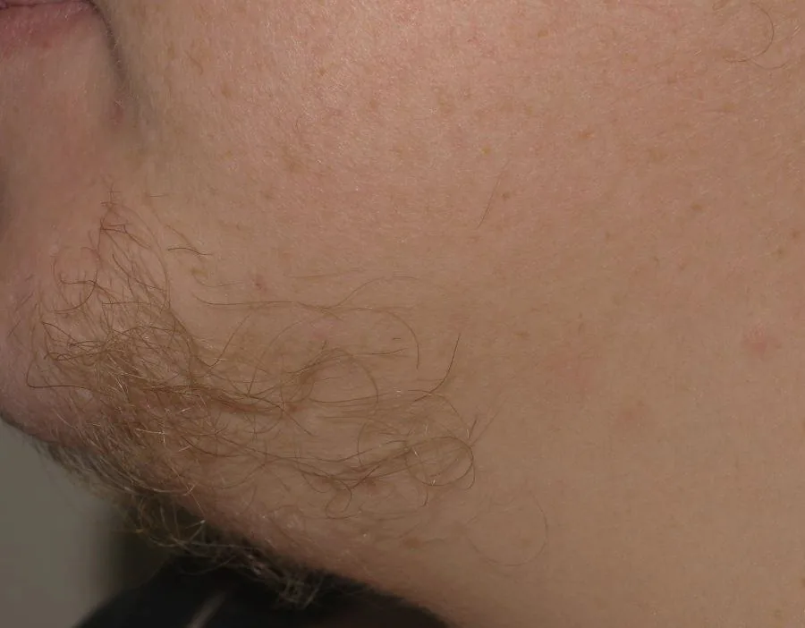 Polycystic ovary syndrome (PCOS) – Clinical: Hirsutism: coarse terminal hair growth on the chin and cheek