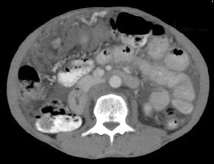 Peritonealkarzinose gynäkologischer Tumoren – Mammographie/MRT: CT (Abdomen, axial, mit Kontrastmittel): Peritonealkarzinose mit „omental cake“ – plattenartig verdicktes, tumorös infiltriertes Omentum direkt unter der vorderen Bauchwand
