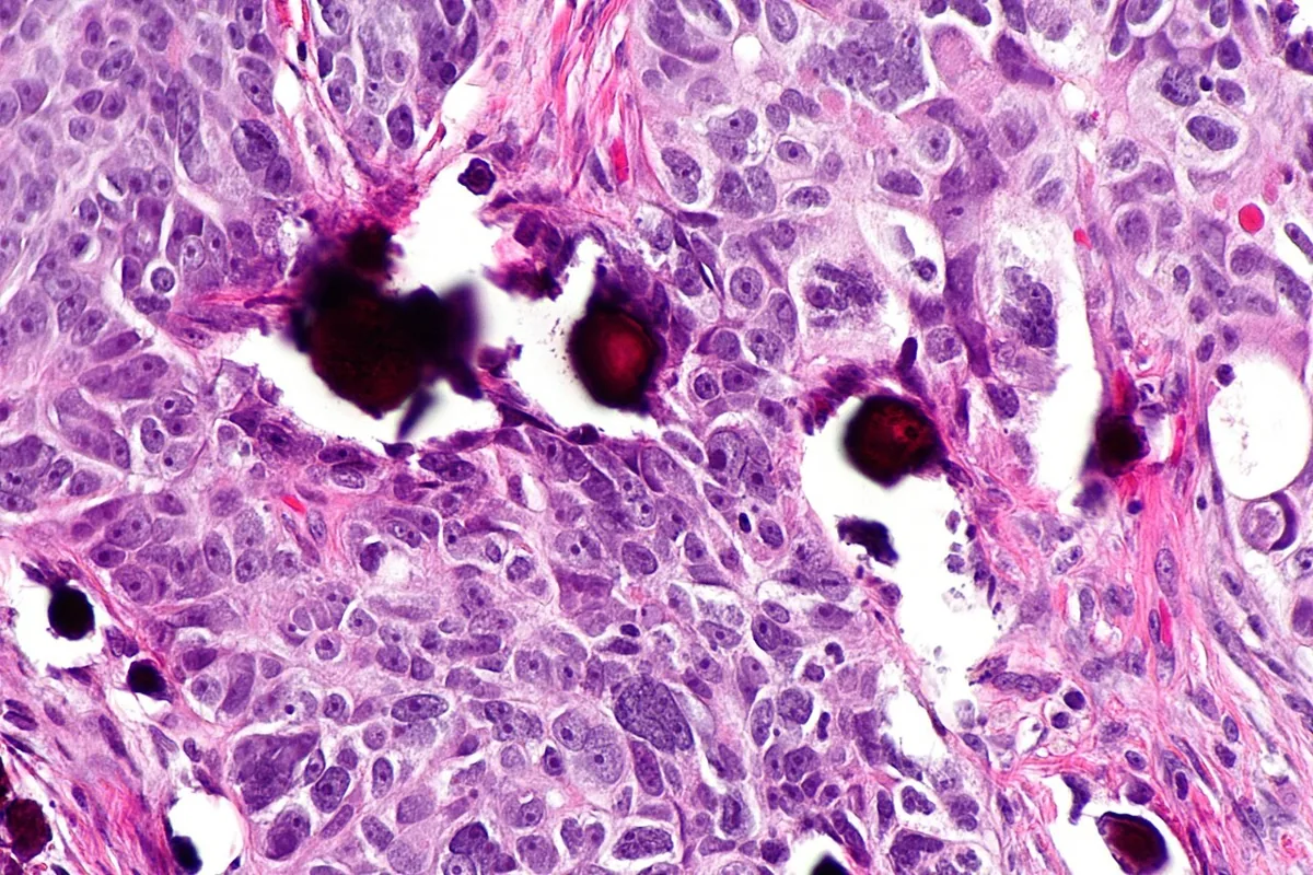 Peritonealkarzinose gynäkologischer Tumoren – Histologie & Zytologie: Histologie (HE): Omentummetastase eines serösen Karzinoms (vermutlich ovariellen Ursprungs) – atypische Tumorzellnester mit Psammomkörpern (dunkle, verkalkte Kugeln)